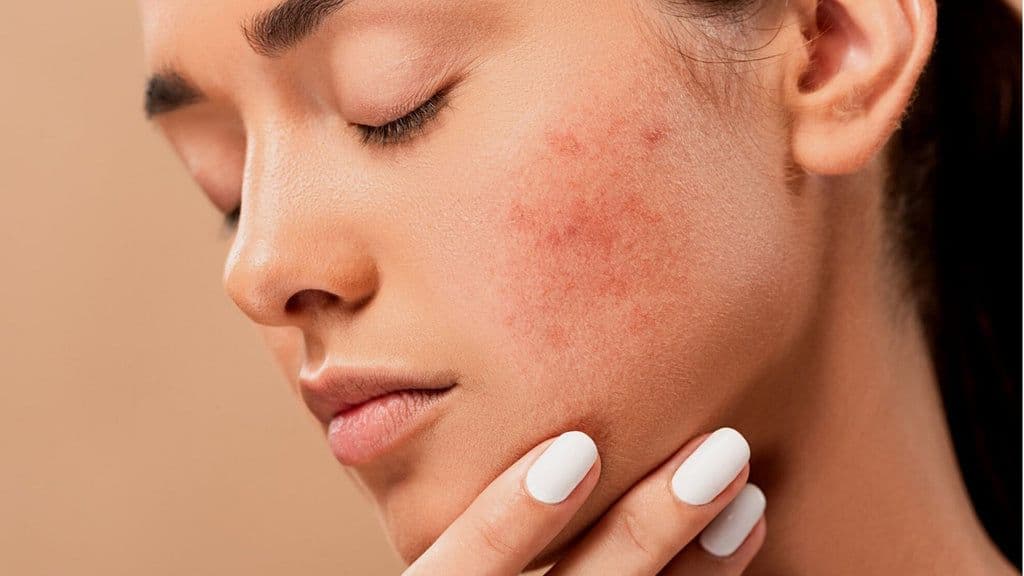 Treatment Guidelines for Acne and Grading of Acne Severity