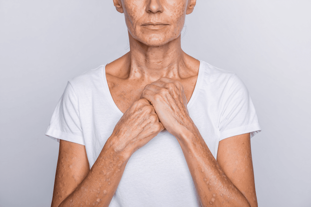 Non-Melanoma Skin Cancer: An Essential Guide