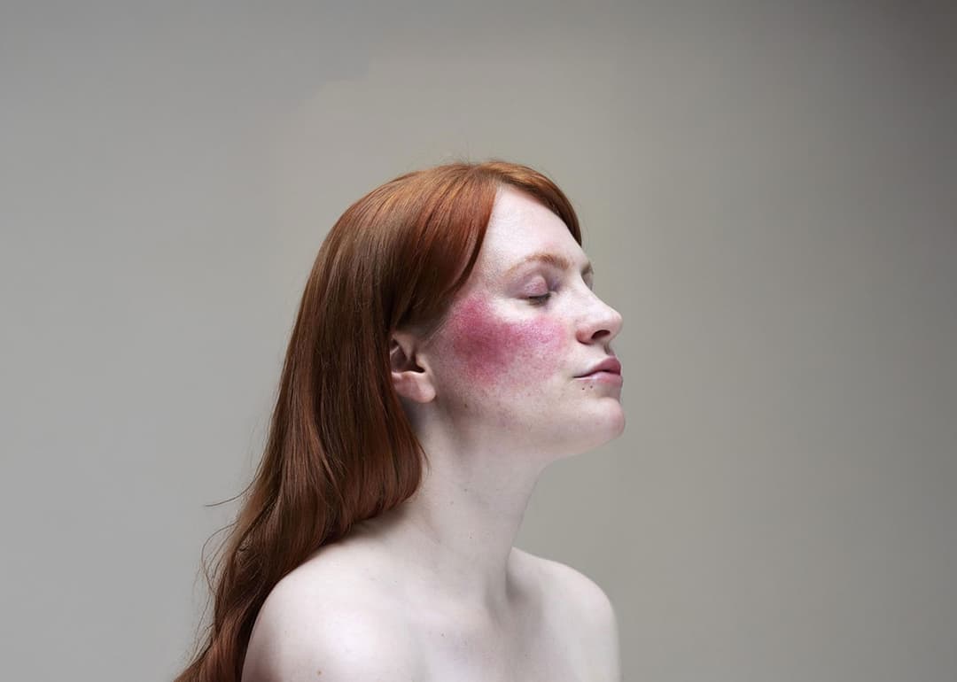 Understanding Acne Rosacea - Battling the Blush