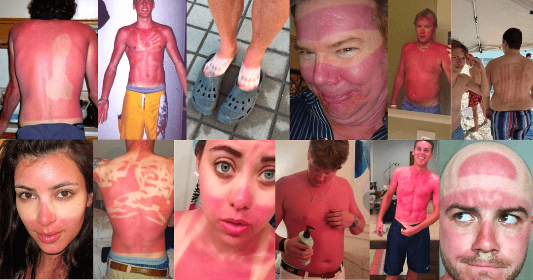 The Accidental Art of Sunburn: A Humorous Look at Photoprotection Failures and the Serious Science Behind Them